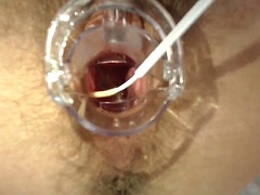 Gynecologist examination with speculum close-up in hairy pussy