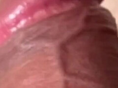 Fordyce Spots My Experience