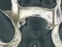 Dildo, Extrem, Införande