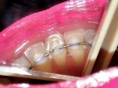 Permanent Retainers Mouth Tour