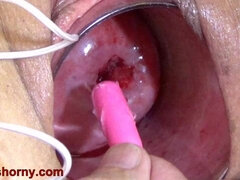 Insertion The Catheter In Cervix Women Mature