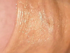 Difficult Fluid Control Due to Straight Phimosis.