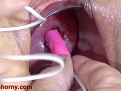 Insertion The Catheter In Cervix Women Mature