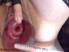 Insertion The Catheter In Cervix Women Mature