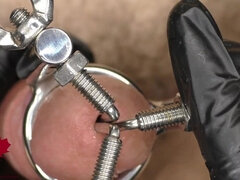 Close up of the Application of a 3-way Urethral Stretcher. the Dilator Is Used to Pre-stretch